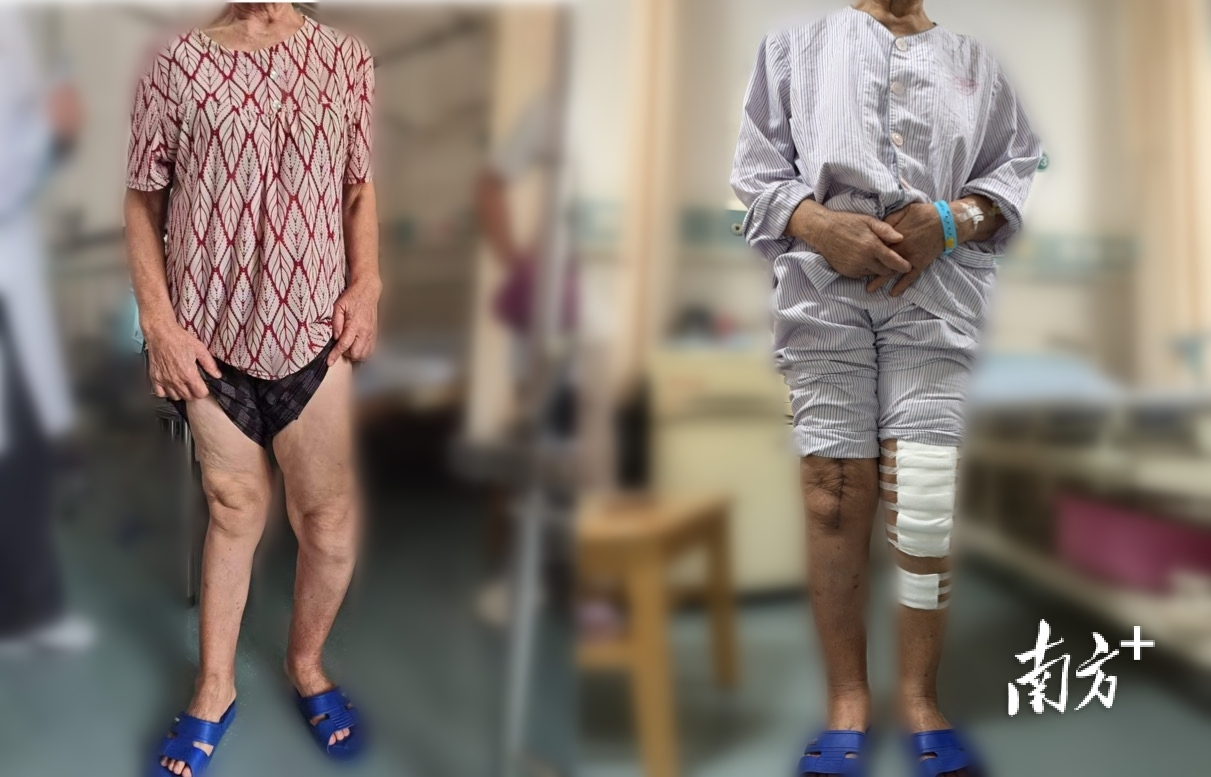 阿婆双腿一正一反歪成 “吹风腿”，机器人辅助手术助她站直走稳
